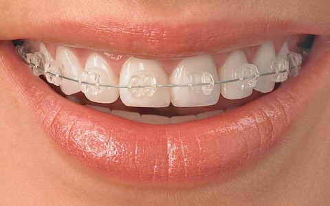 تصحيح الأسنان المعوجة