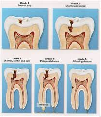What is tooth decay?