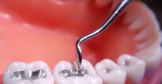 Dental Amalgam Is It Harmless or Not?
