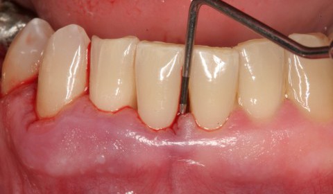 Factors that Causes Gum Disease