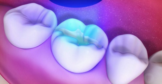 What is White Dental Filling?