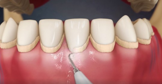 The Serious Outcome of Tartar Formation on Teeth