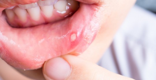 What is Canker Sores?