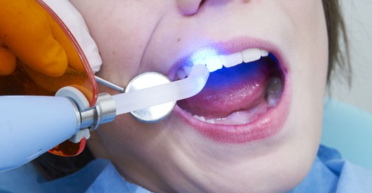 Dental Fillings How Does It Works?