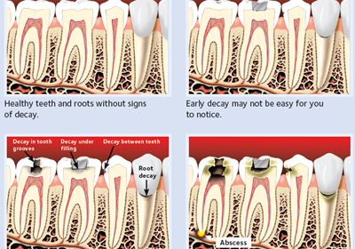 Understanding Tooth Decay