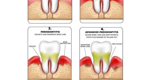 Stages of Gum Disease