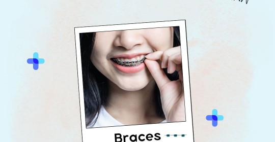 What is Braces or Orthodontic Treatment?